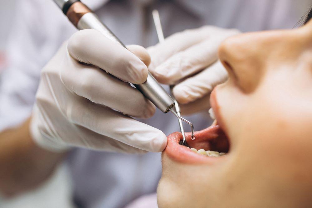 ¿Cuánto tiempo se tarda en colocar un implante dental?