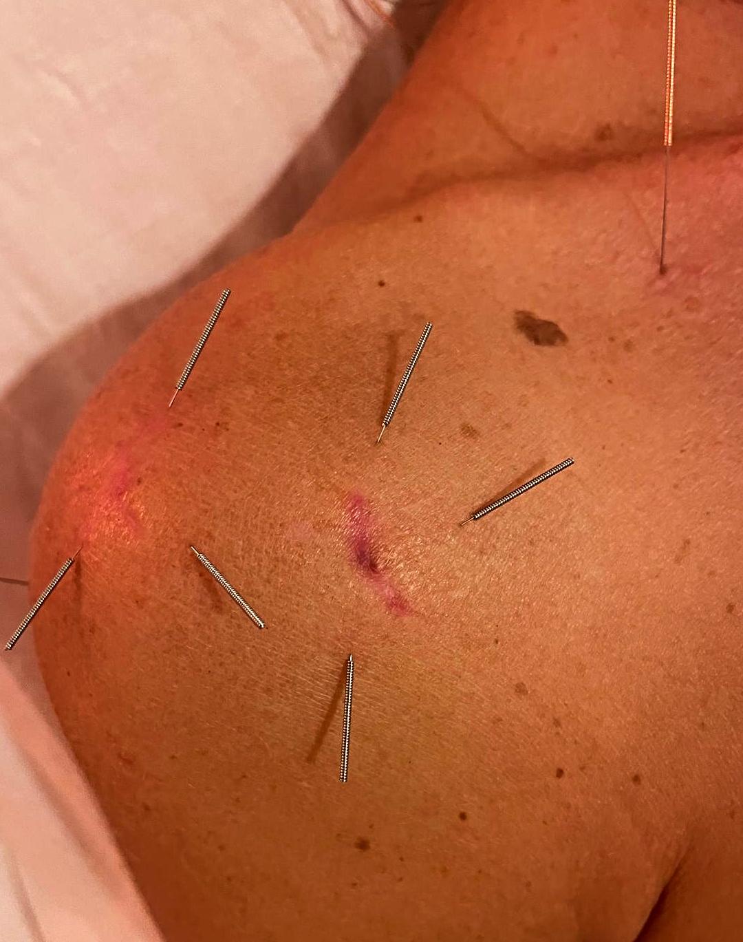 Acupuntura Post Cirugía Artroscópica de hombro/ Acupuncture after Shoulder Arthroscopy Surgery