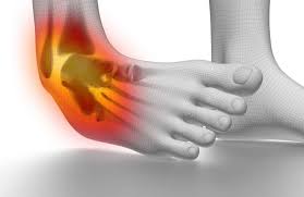 Esguince de Tobillo / Ankle Sprain
