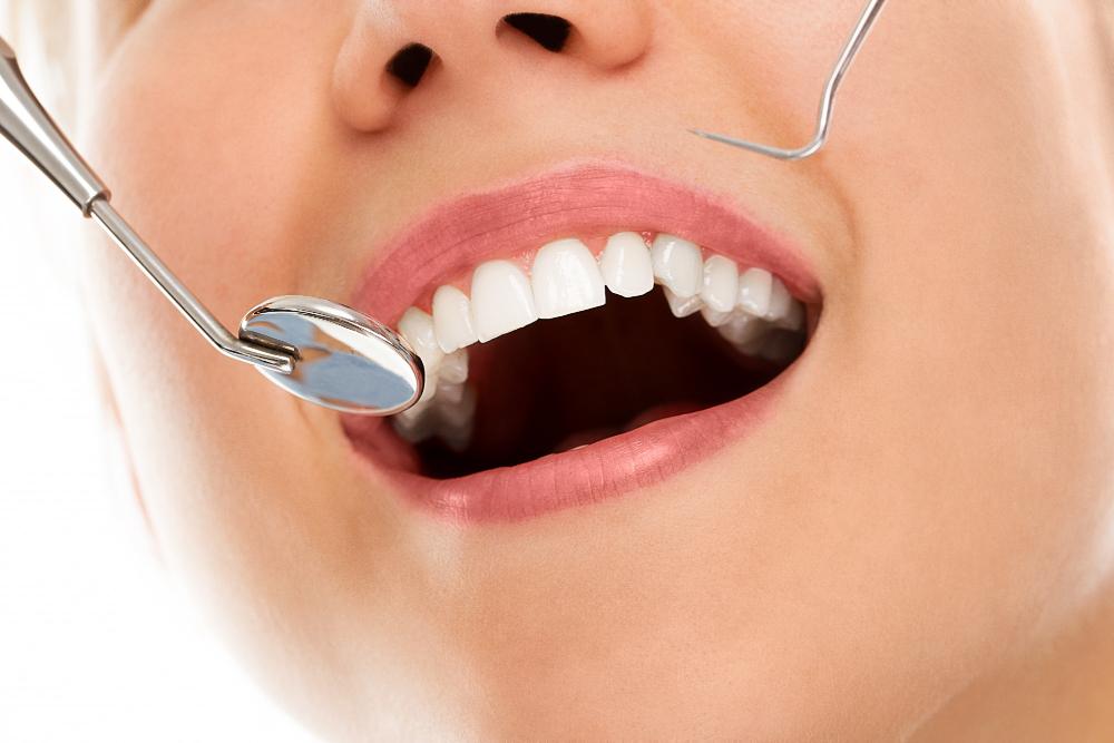 ¿Cuánto tiempo dura el efecto del blanqueamiento dental?