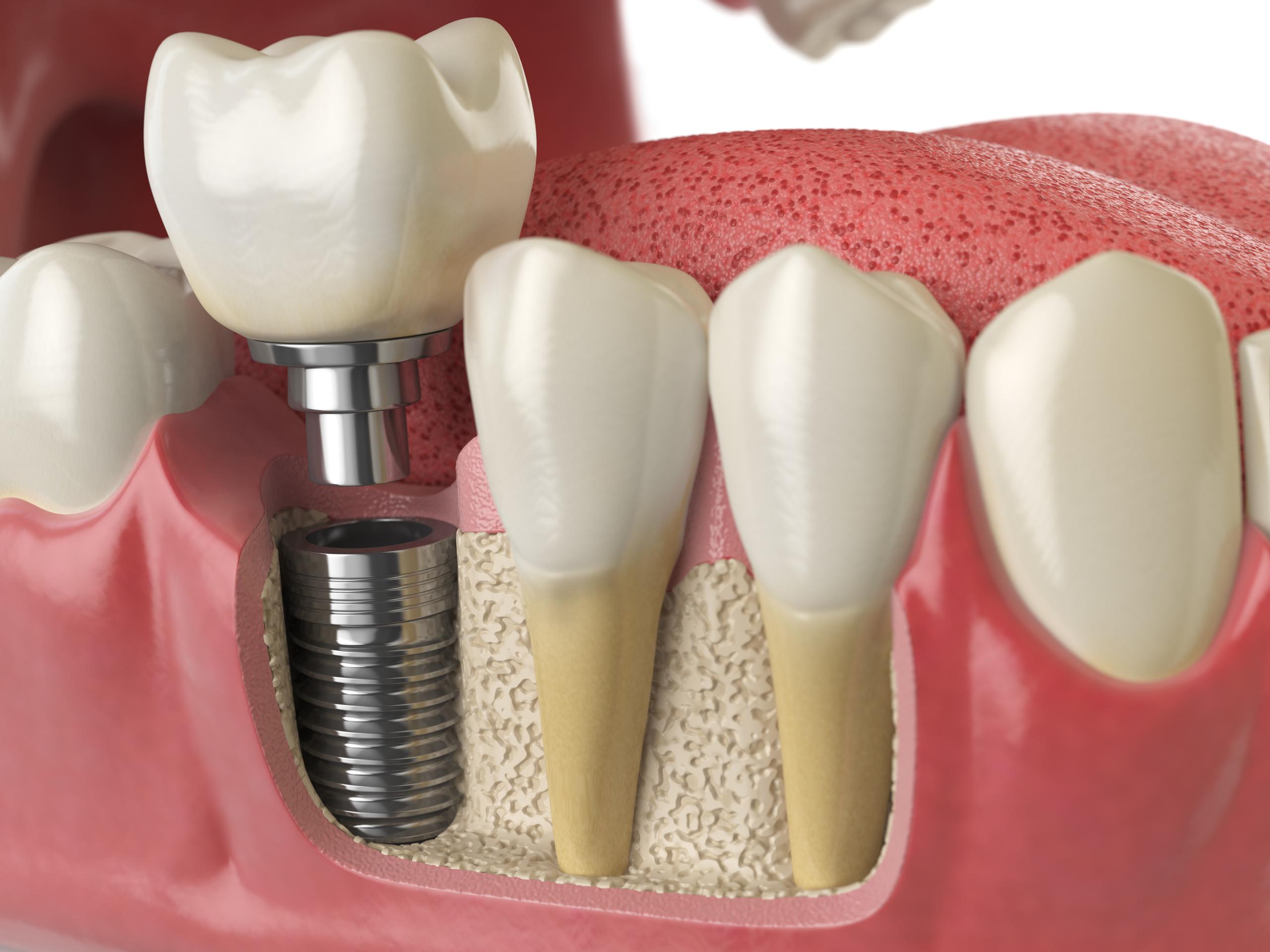 Implantes dentales en Sabadell